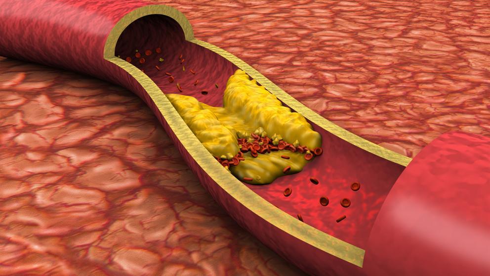 Holesterol može biti dobar, loš i zao