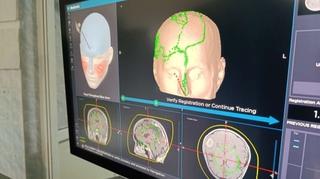 Zenički neurohirurzi obavili prvu operaciju tumora mozga: Upotreba uređaja za neuronavigaciju