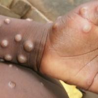 U Belgiji otkrivena nova varijanta virusa Mpox